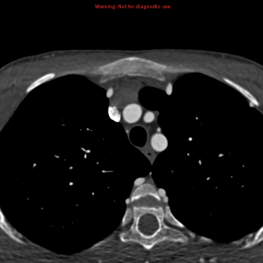 File:Coarctation of the aorta (Radiopaedia 12461-12697 A 14).jpg