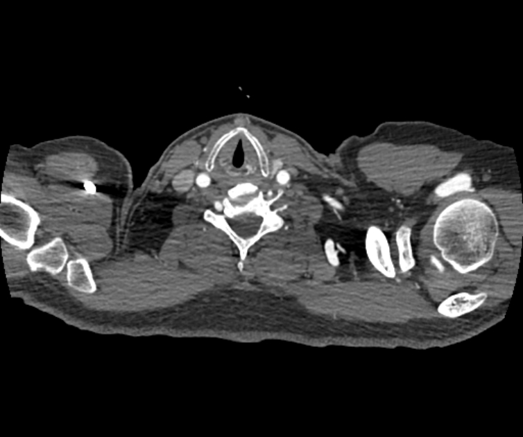 Coarctation of the aorta (Radiopaedia 53752-59822 A 5).jpg