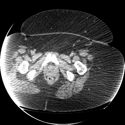 File:Collection due to leak after sleeve gastrectomy (Radiopaedia 55504-61972 A 82).jpg