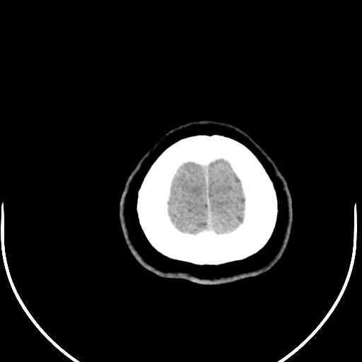 Colloid cyst (Radiopaedia 52865-58792 Axial non-contrast 8).jpg