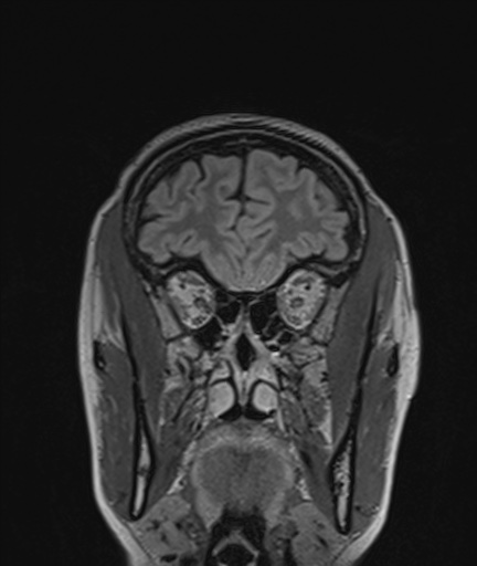 Colloid cyst (Radiopaedia 73154-83877 Coronal FLAIR 21).jpg