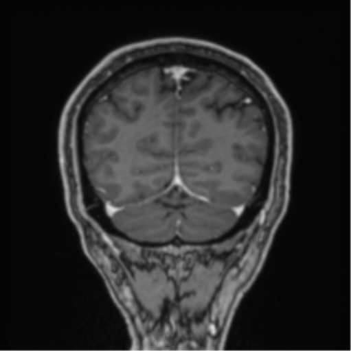 File:Colloid cyst of the third ventricle (Radiopaedia 86571-102662 Coronal T1 C+ 20).png