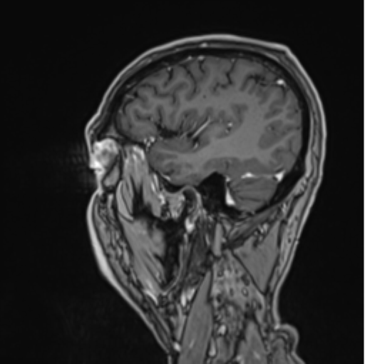 Colloid cyst of the third ventricle (Radiopaedia 86571-102662 Sagittal T1 C+ 17).png