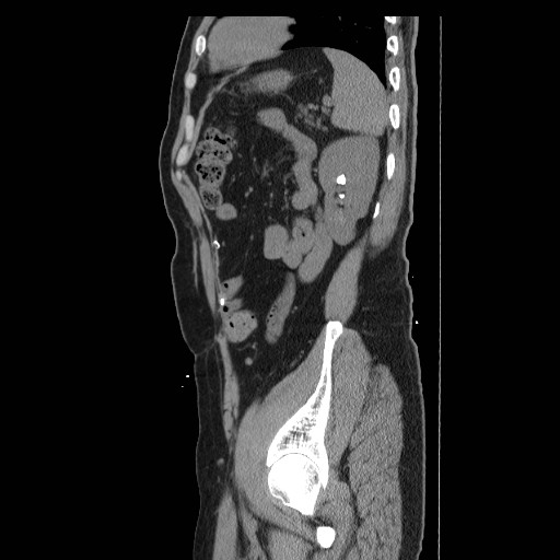 File:Colocutaneous fistula in Crohn's disease (Radiopaedia 29586-30093 C 49).jpg