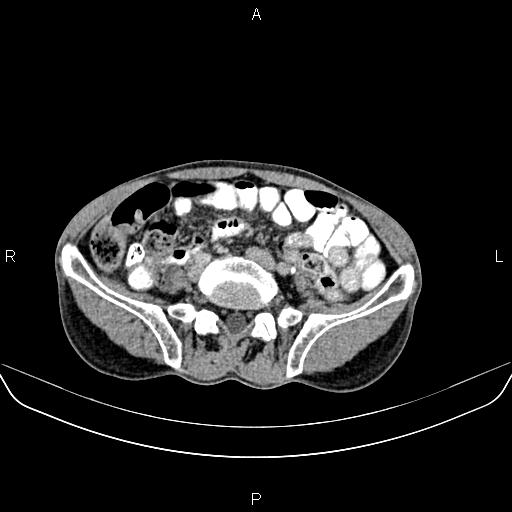 File:Colon adenocarcinoma - hepatic flexure (Radiopaedia 85635-101395 Axial C+ delayed 64).jpg