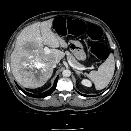Colon adenocarcinoma with calcific liver metastasis (Radiopaedia 55745-62300 B 10).jpg