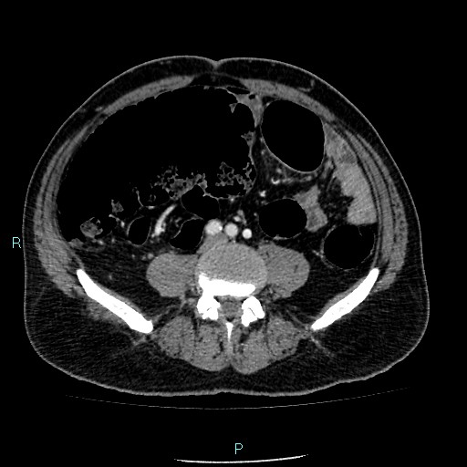 Colon adenocarcinoma with calcific liver metastasis (Radiopaedia 55745-62300 B 28).jpg