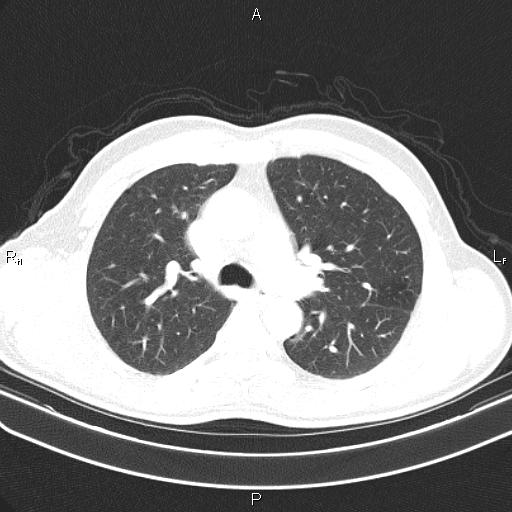 File:Colon cancer (Radiopaedia 85663-101443 Axial lung window 24).jpg