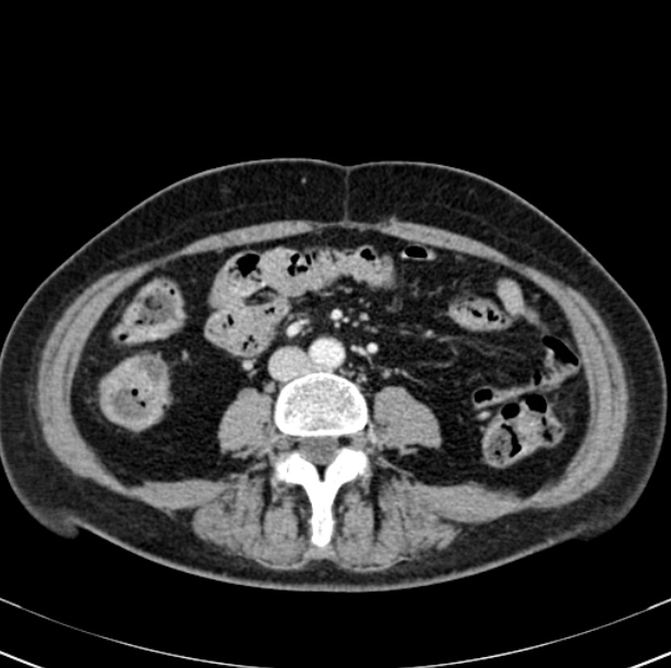 Colon carcinoma with hepatic metastases (Radiopaedia 29477-29961 A 65).jpg