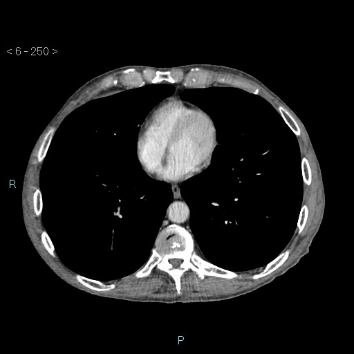 File:Colonic cancer (ultrasound and TC imaging) (Radiopaedia 50346-55713 B 250).jpg