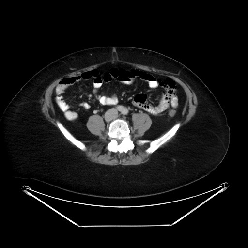File:Colonic intussusception due to adenocarcinoma (Radiopaedia 86828-102987 A 96).jpg