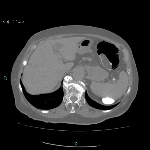 File:Colonic lipomas (Radiopaedia 49137-54244 Axial bone window 52).jpg