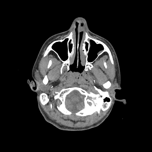 Nasal pyogenic granuloma (lobular capillary hemangioma) (Radiopaedia 85536-101244 Axial non-contrast 41).jpg