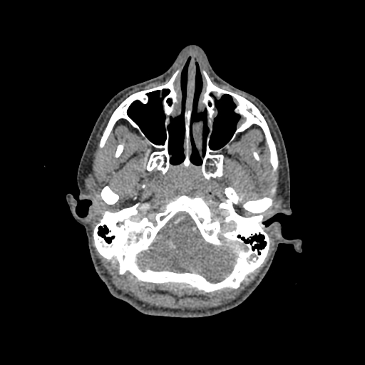 File:Nasal pyogenic granuloma (lobular capillary hemangioma) (Radiopaedia 85536-101244 C 64).jpg