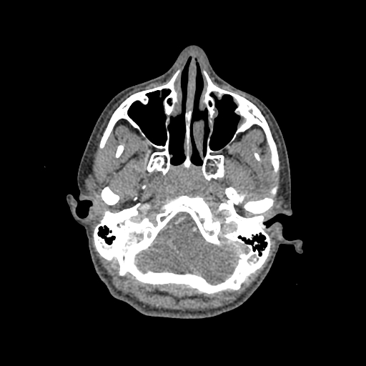 Nasal pyogenic granuloma (lobular capillary hemangioma) (Radiopaedia 85536-101244 C 65).jpg