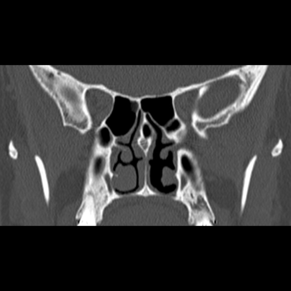 Nasal septal perforation (Radiopaedia 25030-25289 Coronal bone window 47).jpg