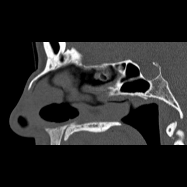 Nasal septal perforation (Radiopaedia 25030-25289 Sagittal bone window 27).jpg