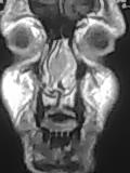 File:Nasal septum hematoma (Radiopaedia 6778-7968 F 1).jpg