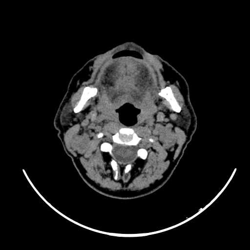 File:Nasopharyngeal carcinoma - infiltrating the clivus (Radiopaedia 62583-70875 Axial non-contrast 31).jpg