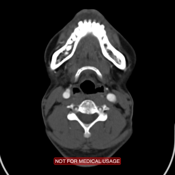 File:Nasopharyngeal carcinoma recurrence - skull base destruction (Radiopaedia 29107-29491 A 22).jpg