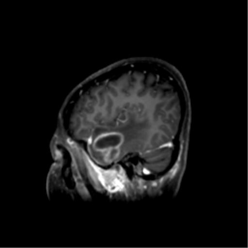 File:Nasopharyngeal carcinoma with cerebral abscess (Radiopaedia 43018-46274 J 16).png