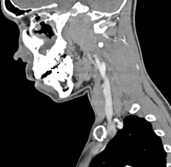 File:Nasopharyngeal carcinoma with skull base invasion (Radiopaedia 53415-59705 C 48).jpg