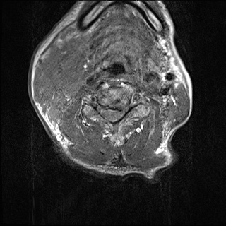 File:Nasopharyngeal carcinoma with skull base invasion (Radiopaedia 59258-66600 Axial T1 1).jpg