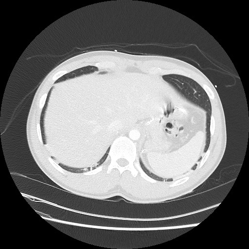 Near-drowning pulmonary edema (Radiopaedia 59457-66814 Axial lung window 51).jpg