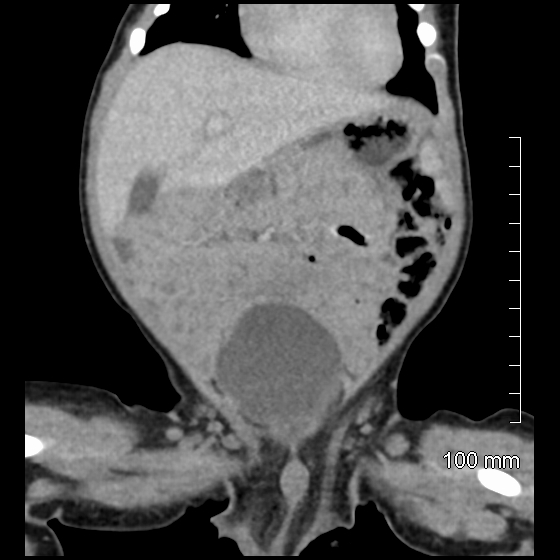 File:Neonatal neuroblastoma (Radiopaedia 56651-63438 Coronal non-contrast 17).jpg