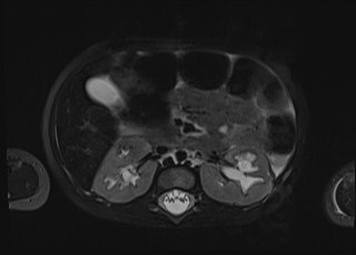 Neonatal prostatic utricle abscess - cyst (Radiopaedia 69511-79394 Axial T2 fat sat 53).jpg