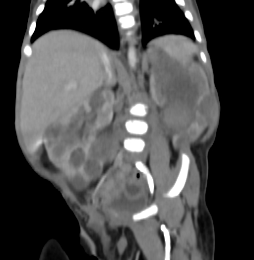 Nephroblastomatosis (Radiopaedia 71294-81607 B 215).jpg