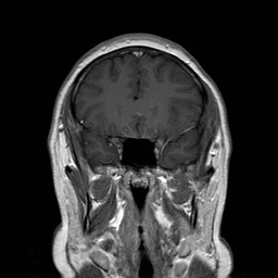 File:Neuro-Behcet's disease (Radiopaedia 21557-21505 Coronal T1 C+ 5).jpg
