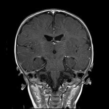 File:Neurofibromatosis type 1 (Radiopaedia 30089-30671 Coronal T1 C+ 16).jpg