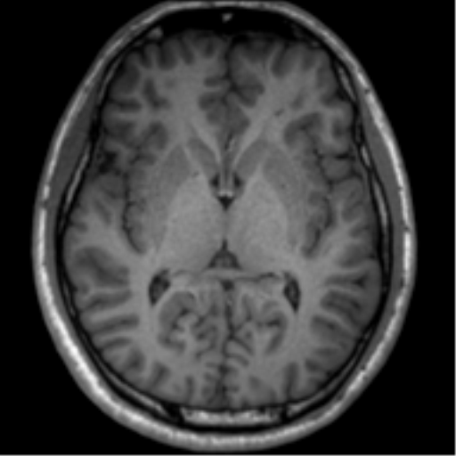 File:Neurofibromatosis type 2 (Radiopaedia 44936-48838 Axial T1 74).png