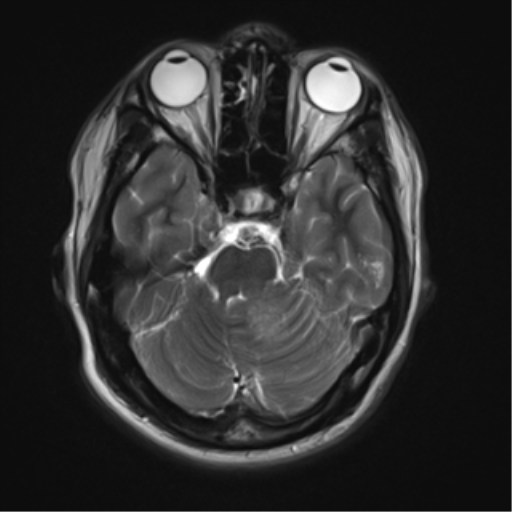 File:Neurofibromatosis type 2 (Radiopaedia 44936-48838 Axial T2 7).png