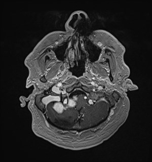 Neurofibromatosis type 2 (Radiopaedia 79097-92049 Axial T1 C+ 36).jpg
