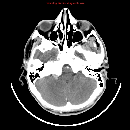 File:Neurofibromatosis type 2 (Radiopaedia 8953-9732 C 5).jpg