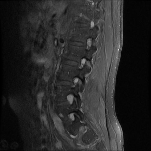 File:Neurofibromatosis type 2 (spinal manifestations) (Radiopaedia 53943-60070 K 4).png