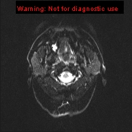 File:Neuroglial cyst (Radiopaedia 10713-11184 Axial DWI 22).jpg