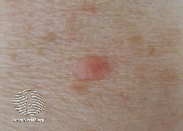 File:Nodular basal cell carcinoma, arm (DermNet NZ nbcc-arm-25dn).jpg