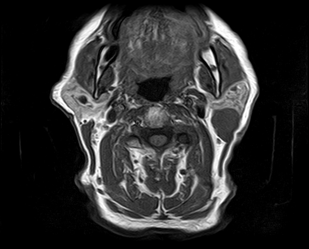 File:Non-Hodgkin lymphoma - parotid gland (Radiopaedia 71531-81890 Axial T1 10).jpg