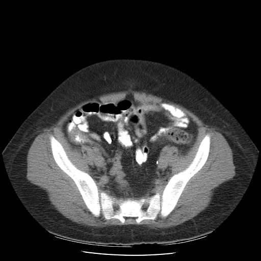 File:Non-Hodgkin lymphoma involving pelvis (Radiopaedia 21281-21197 B 50).jpg