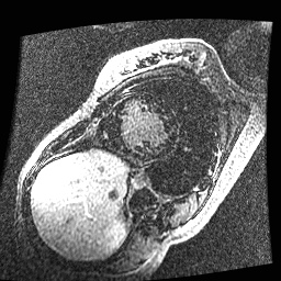 File:Non-compaction of the left ventricle (Radiopaedia 38868-41062 E 8).jpg