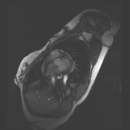 File:Non-compaction of the left ventricle (Radiopaedia 38868-41062 SAXs SSFP CINE 27).jpg