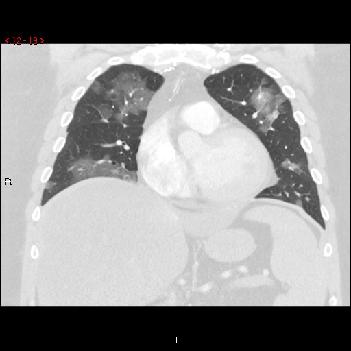 File:Non-specific interstitial pneumonitis (Radiopaedia 27044-27222 Coronal lung window 19).jpg