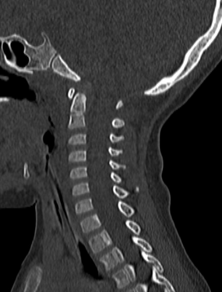 Normal CT cervical spine - pediatric (Radiopaedia 52549-58462 Sagittal bone window 117).jpg