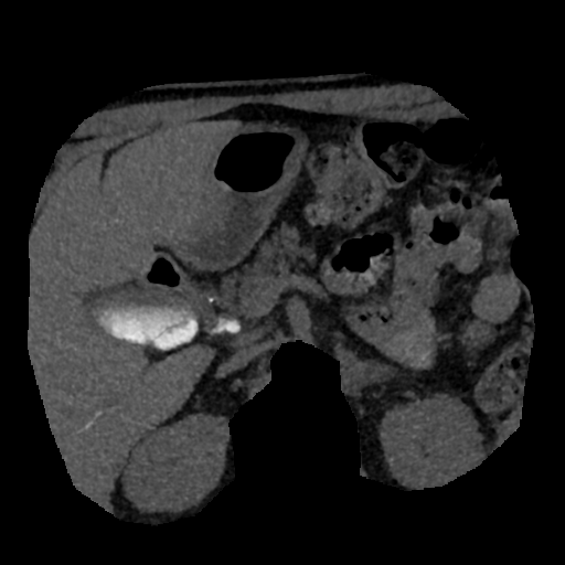 File:Normal CT intravenous cholangiogram (Radiopaedia 38199-40208 Axial IVC (MIP) 41).png