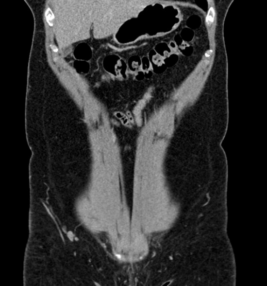 File:Normal CT intravenous urogram (Radiopaedia 39444-41759 A 192).jpg