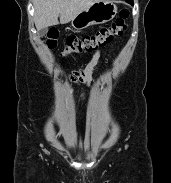 Normal CT intravenous urogram (Radiopaedia 39444-41759 A 195).jpg