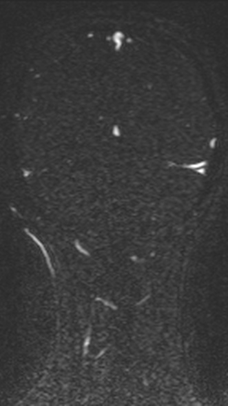 Normal MRI brain with MRV- teenager (Radiopaedia 49425-54553 Coronal MRV 185).jpg